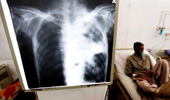 tuberculosis--696x411