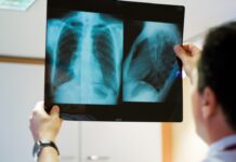 Cáncer de pulmón: un nuevo informe revela el estado de la enfermedad en el país y los desafíos por enfrentar en su abordaje