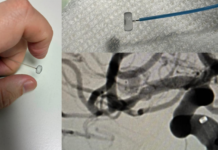 Inédita intervención endovascular en el Hospital «San Martín» de La Plata