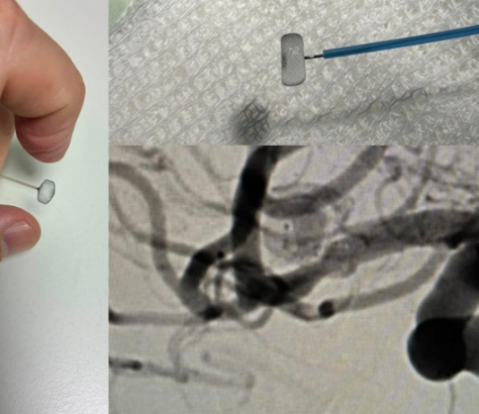 Inédita intervención endovascular en el Hospital «San Martín» de La Plata